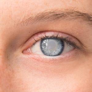 cataract eye surgery best dr arslan